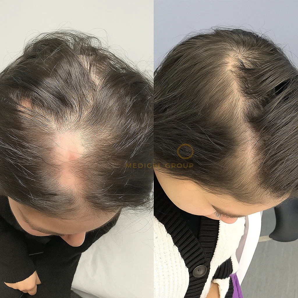 Hair Growth Vitamins For Women