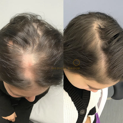 Hair Growth Vitamins For Women